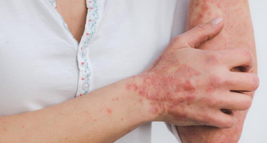 woman scratching her hands with psoriasis