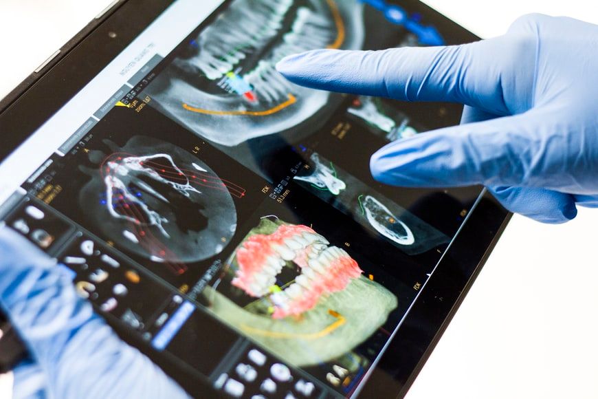 Teeth X-ray in preparation for dental implants