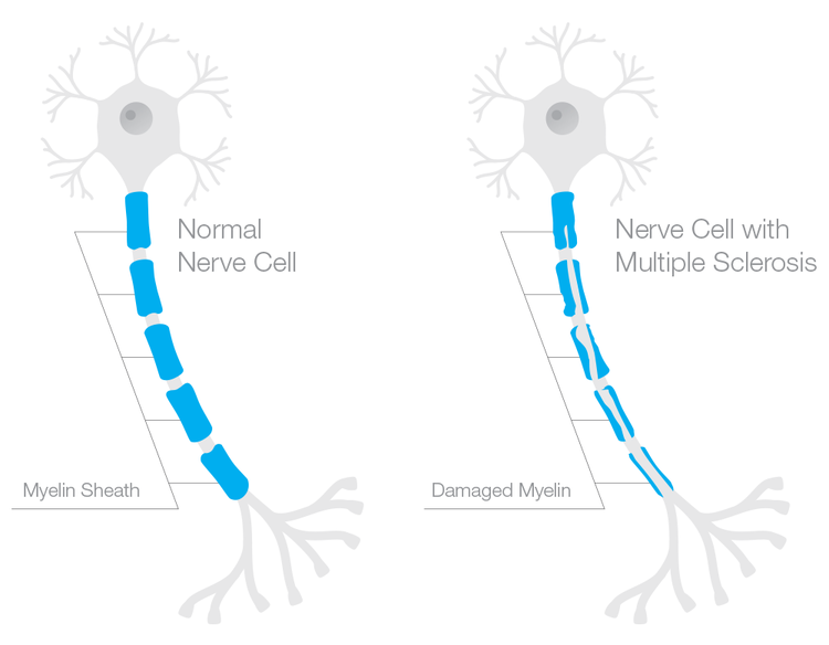 Normal nerve cell vs Nerve cell with Multiple Sclerosis