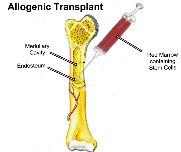 allogenic transplant treatment for multiple myeloma
