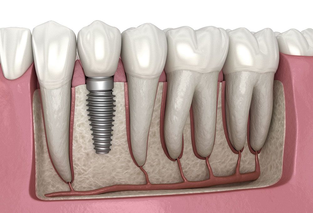 illustration of dental implants