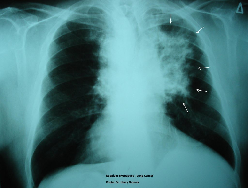 Xray result shows the hazy white image as lung cancer tumor