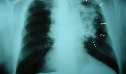 lung cancer xray showing a tumor
